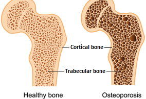 Bone