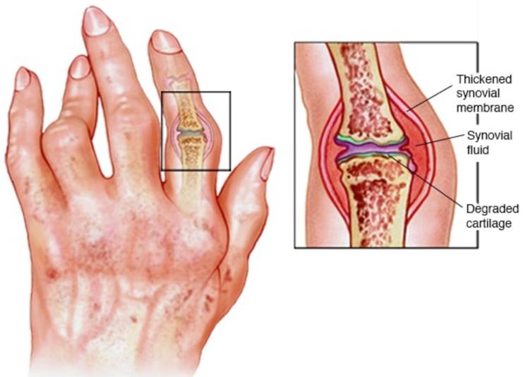 Osteoarthritis
