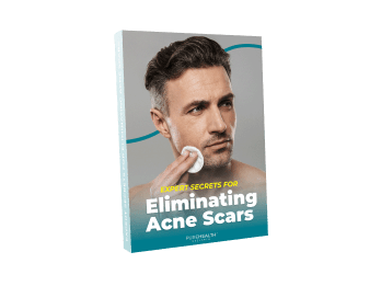 Expert Secrets for Eliminating Acne Scars