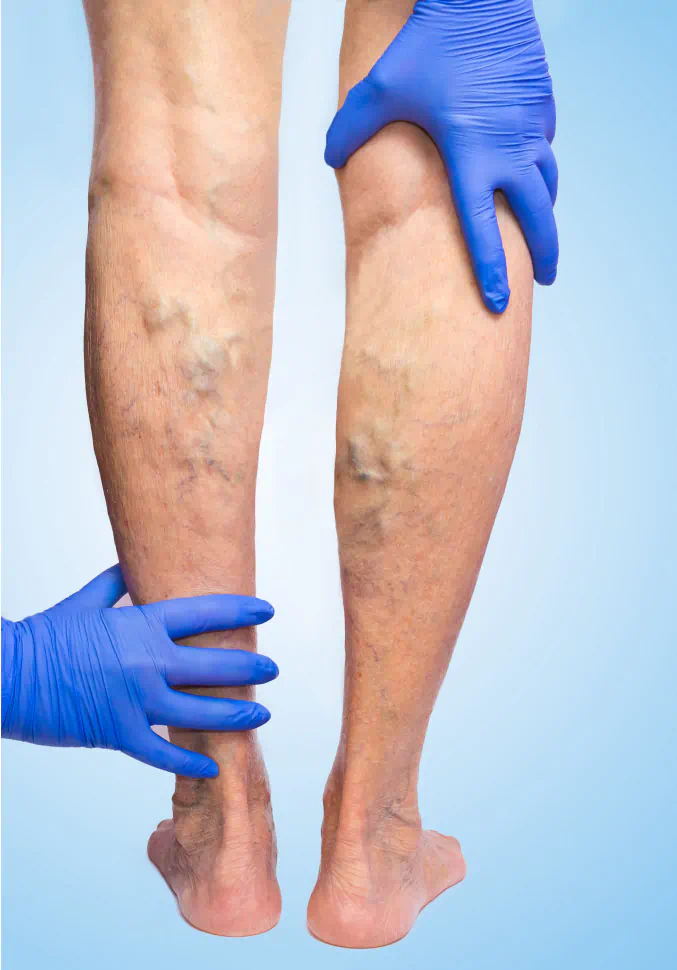 Varicose